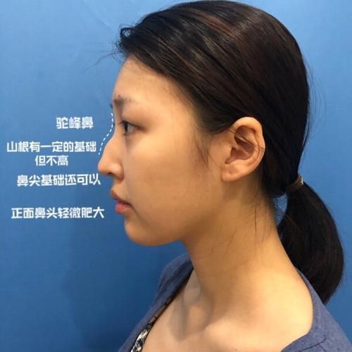 駝峰鼻子(真的能通過手術變得更美嗎)